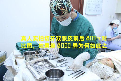 真人实拍切开双眼皮前后 🐬 对比图，效果差 🐋 异为何如此之大